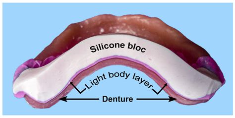 q-seal|q seal denture.